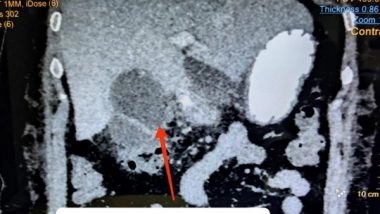 India News | Post-COVID Gall Bladder Gangrene Cases Reported in India