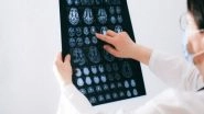 Health News | Predicting Possible Alzheimer's with Nearly 100 Per Cent Accuracy: Study