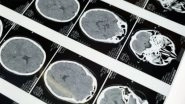 Science News | Preventing Long-term Effects of Traumatic Brain Injury: Study