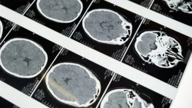 Science News | Preventing Long-term Effects of Traumatic Brain Injury: Study