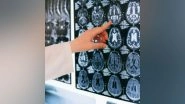 Science News | Study Shows Epilepsy Brain Implant Does Not Transform Patients' Personality