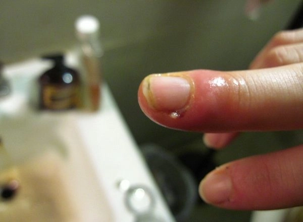 Low-Cost Screen-Printed Carbon Sensors Used To Rapidly Detect Bacteria Commonly Found in Wounds