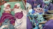 Conjoined Israeli Twins Finally Able To See Each Other Face-to-Face After Being Separated by Rare 12-Hour Surgery