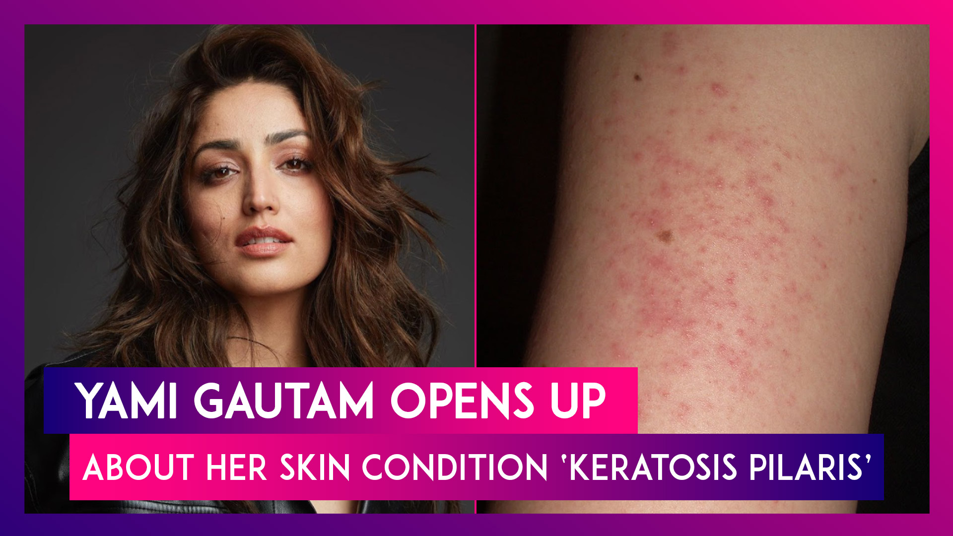 Yammy Goatam Xxx - Yami Gautam Opens Up About Her Skin Condition Keratosis Pilaris: What Are  Its Causes, Symptoms | ðŸ“¹ Watch Videos From LatestLY