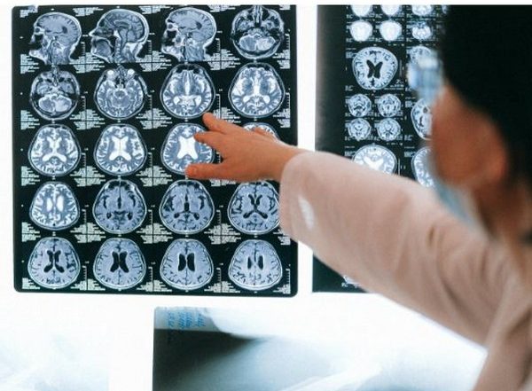 Science News | Researchers Find Warning Signs That Can Indicate Impending Dementia in Blood