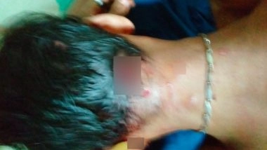 India News | Mumbai: Man Injured in Leopard Attack Hospitalised