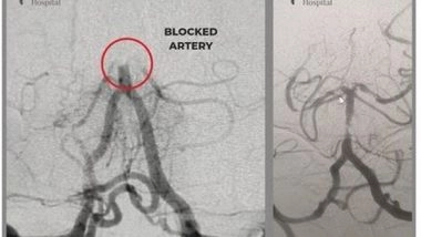 Business News | Mechanical Thrombectomy - a Treatment of Choice for Acute Ischemic Stroke