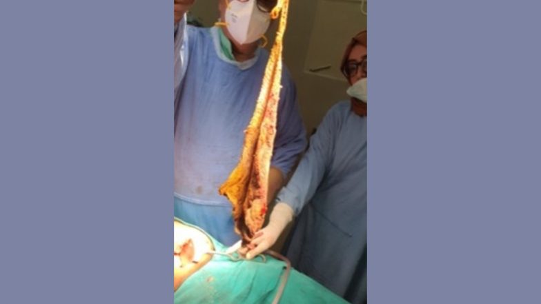 Aligarh: Surgical Sponges Left in Abdomen Removed Successfully at JNMC