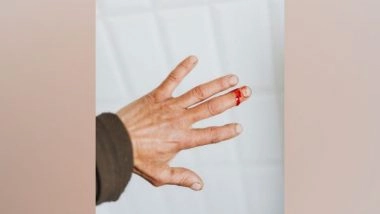 Health News | Research: Mechanosensor Plays Critical Role in Skin Wound Healing