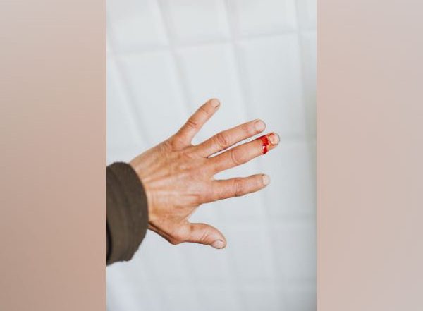Health News | Research: Mechanosensor Plays Critical Role in Skin Wound Healing