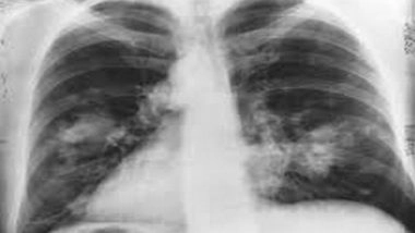 India News | Faridabad Hospital Introduces Cryo Technique for Lung Cancer Treatment