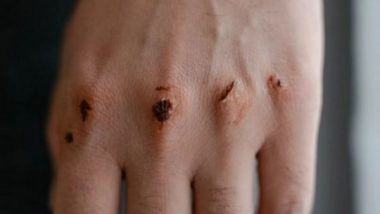 Science News | Researchers Reveal Critical Role of Mechanosensor in Skin Wound Healing