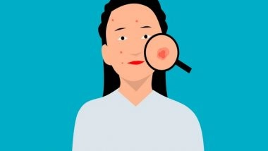 Health News | Study Finds Skin Infections Cause of Rheumatic Fever