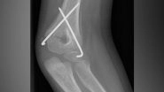 Health News | New Target Therapy to Protect Bones During Ageing Found During Research