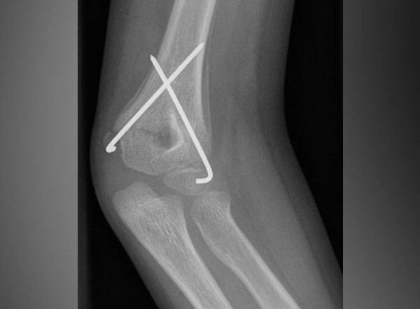 Health News | New Target Therapy to Protect Bones During Ageing Found During Research
