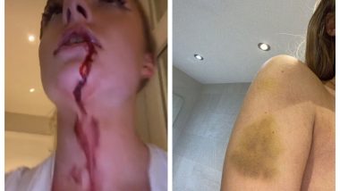 Mason Greenwood’s Girlfriend Harriet Robson Accuses Footballer of Physical Violence, Posts Pictures and Video of her Bruises on Instagram