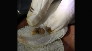 3 Live Human Botflies Removed From American Woman’s Eye in Successful Surgery at Delhi Hospital (See Pic)