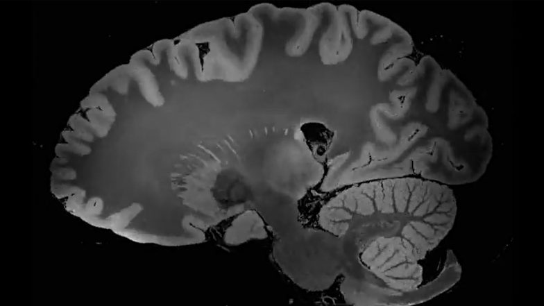 Brain Activity Of 87-Year-Old Dying Man Reveals That The Entire Life History Flashes Before Our Eyes In Final Moments; Watch Video