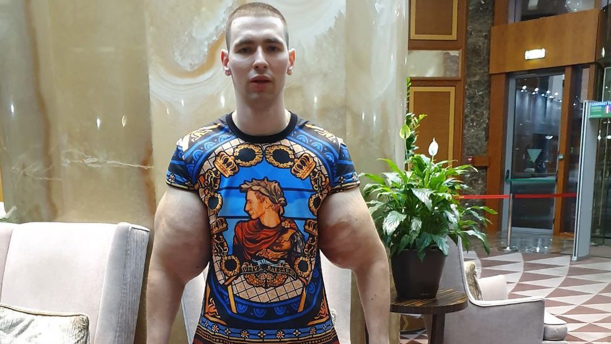 Russian Popeye' leaves fans worried with his artificially-pumped arms -  India Today
