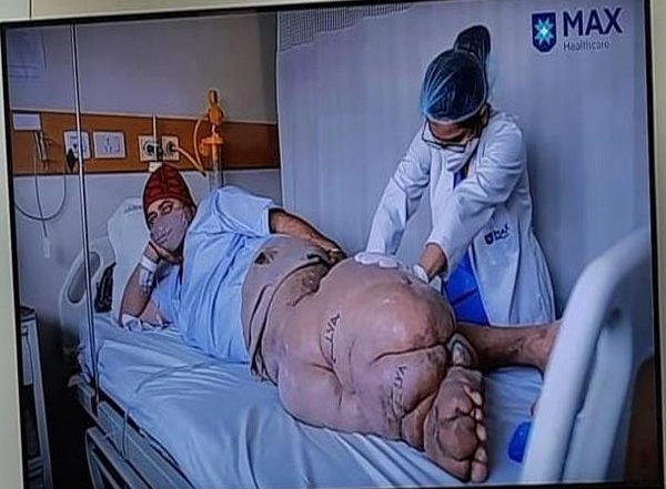 India News | Surgery Helps Delhi Man Bedridden with 45-kg Elephantiasis Leg Walk for First Time in 10 Years