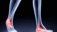 India News | Ayush Ministry to Start Phase-III Clinical Trial on Efficacy of Ayurveda in Treatment of Rheumatoid Arthritis