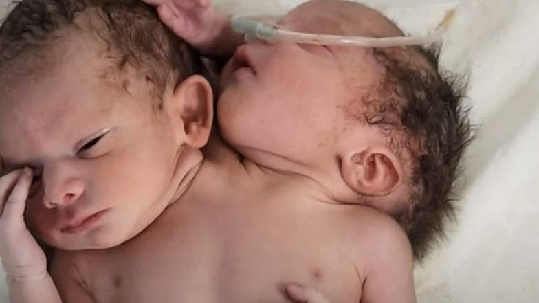 Madhya Pradesh: Woman Gives Birth to Baby With Two Heads, Three Hands in Ratlam