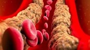 Health News | High Triglycerides May Increase Risk of Second Stroke, Suggests Study