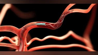 Business News | Medtronic Commences PRAAN, India's First-ever Clinical Registry to Assess the Role of Brain Blood Clot Retrieving Devices in Stroke Patients