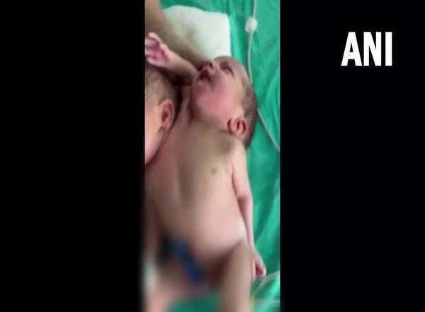 India News | Woman in MP's Ratlam Gives Birth to Child with Two Heads, Three Arms
