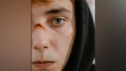 Lifestyle News | People with Facial Scars Rate Their Own Appearance Worse Than Surgeons, Strangers: Study
