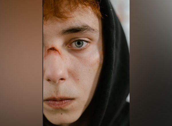 Lifestyle News | People with Facial Scars Rate Their Own Appearance Worse Than Surgeons, Strangers: Study