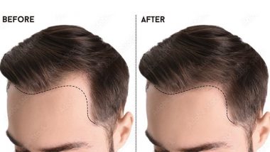 Best Hair Transplant Centers – Latest News Information updated on March 25,  2022 | Articles & Updates on Best Hair Transplant Centers | Photos & Videos  | LatestLY