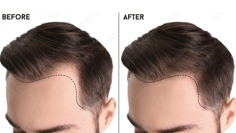 Best Hair Transplant Centers in Turkey and Turkish Hair Transplant Costs |  🛍️ LatestLY