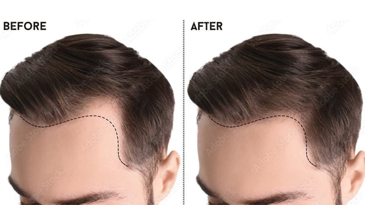 FUE Hair Transplant in Delhi FUE Hair Transplant Treatment in Delhi