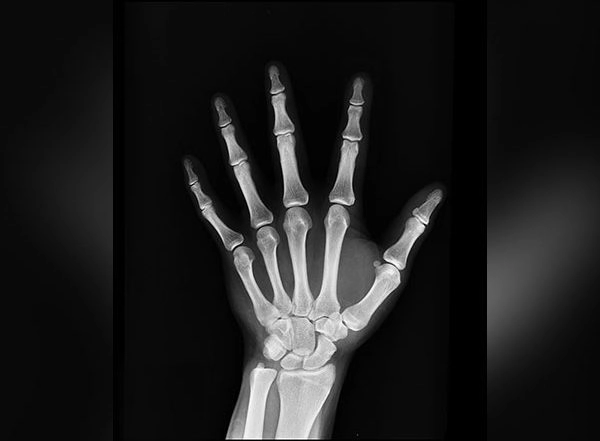 Hormone Levels Can Predict Bone Loss in Premenopausal Women: Study