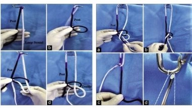 Business News | Doctor at Sakra World Hospital Invents a New Form of Arthroscopy Knot - The Banarji's Knot