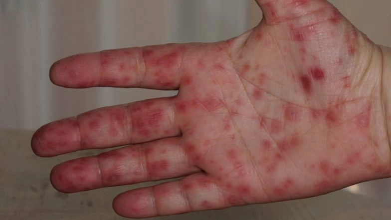 Everything You Need to Know About Tomato Flu