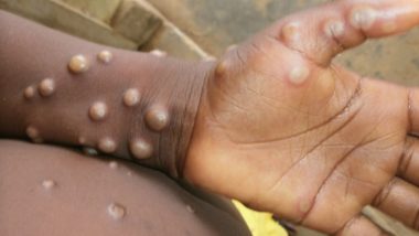 Monkeypox Cases in UK Pass 1,000, World Total Now 3,413: UKSHA's Report