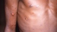 Monkeypox Outbreak: From US to Portugal, Here is a List of Countries Affected by Smallpox-Like Infection