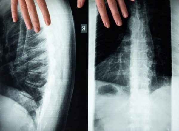 Scientists Discover Treatment of Spinal Cord Injuries