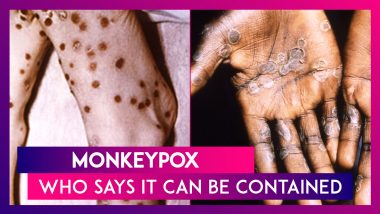 Monkeypox Virus: More Than 100 Cases Confirmed In Europe, America, Australia, But WHO Says It Can Be Contained