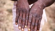 Monkeypox May Slow Down But Not be Eliminated, Says Report