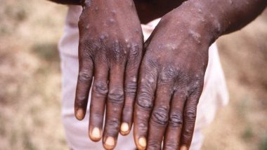 Italy: Man Tests Positive for Monkeypox, COVID-19 and HIV at the Same Time After Returning From Spain