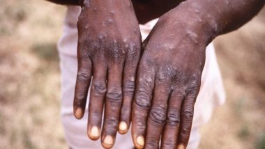 World News | Tanzania Issues Alert over Monkeypox as Outbreak Reported in Europe