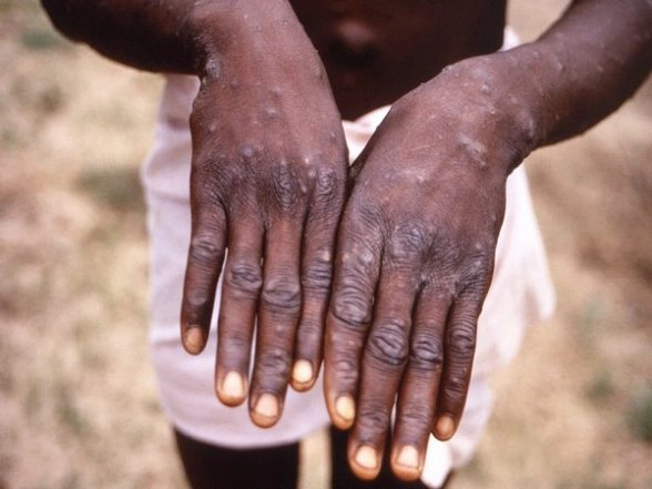 Monkeypox Outbreak: US CDC Issues New Warning As More Potential Cases Found