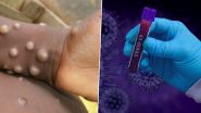 Monkeypox Doesn’t Spread via Air Like COVID-19: US CDC
