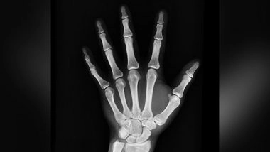 Science News | Bone Fractures in Cancer Patients Can Be Predicted Using AI: Research