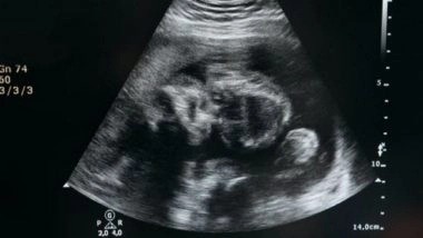 Lifestyle News | Study Finds Human Fetuses Evolved to Slow Shoulder Growth for Easier Delivery