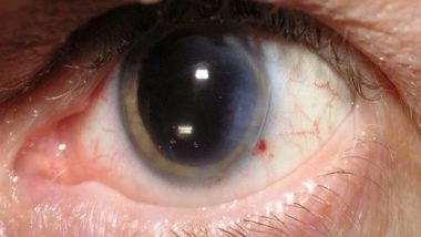 India News | Govt Aims to Clear Backlog of About 1.02 Crore Cataract Surgeries from June 1