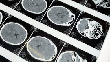 Science News | Researchers Find New Approach for Treatment of Devastating Brain Tumours
